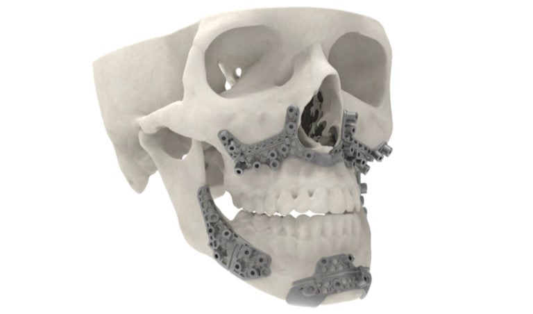 3D Systems Announces All New VSP Hybrid Surgical Guides - 3Dnatives