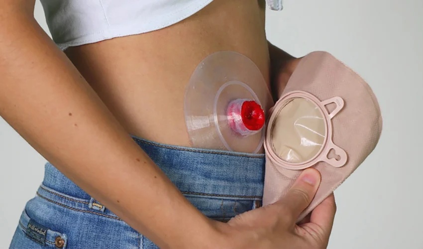 Odapt, a 3D Printed Disc for Ostomy Bags That Does Not Cause
